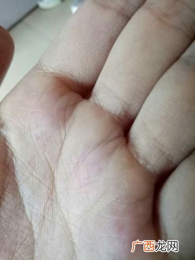 茧子怎么去除,怎么除去握笔时长出的茧?