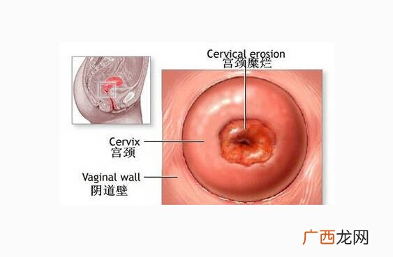 宫颈炎怎么造成的,宫颈炎是什么原因？