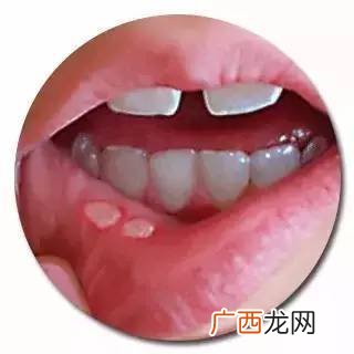 为什么会得口腔溃疡,口腔溃疡是什么引起的，嘴巴都肿了，怎么办？