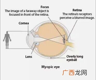 屈光不正是什么意思,屈光不正的矫正方法有哪些？