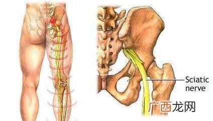 坐骨神经在哪里,坐骨神经疼的部位？