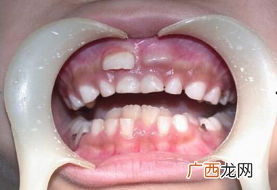 乳牙有牙根吗,乳牙的根连着恒牙吗？