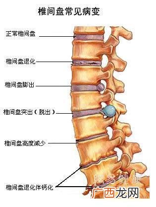 腰椎间盘突出是什么原因造成的,腰椎间盘突出是什么原因引起的？