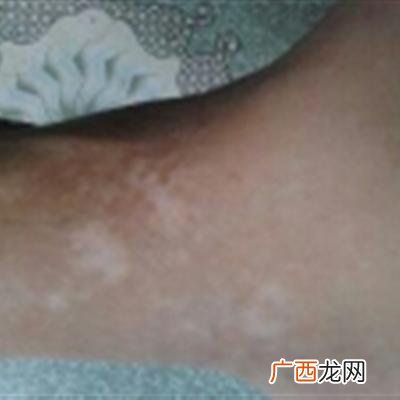 身体有白斑是什么原因,皮肤长白斑怎么回事？