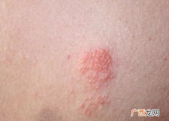带状疱疹是什么病,带状疱疹是什么病？