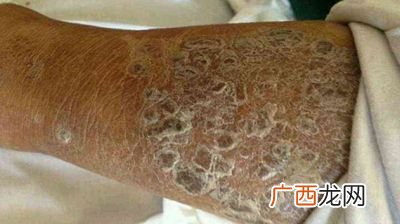 糙皮病是什么病,氨基酸保湿产品具有修复角质层作用的是？
