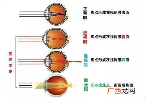 屈光是什么意思,屈光名词解释？