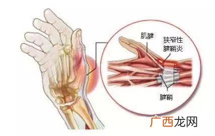 腱鞘炎是什么病,得了腱鞘炎怎么办？