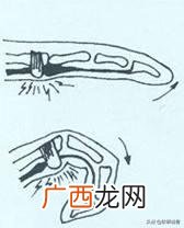 腱鞘炎是什么病,得了腱鞘炎怎么办？