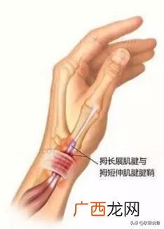 腱鞘炎是什么病,得了腱鞘炎怎么办？