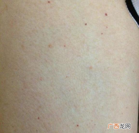 身体出现小红点是什么原因,身上好多小红点是怎么回事？