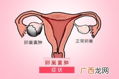 卵巢囊肿症状有哪些,卵巢囊肿疼吗？
