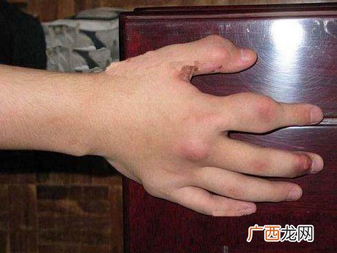 尿酸高是什么毛病,尿酸高是什么原因造成的？
