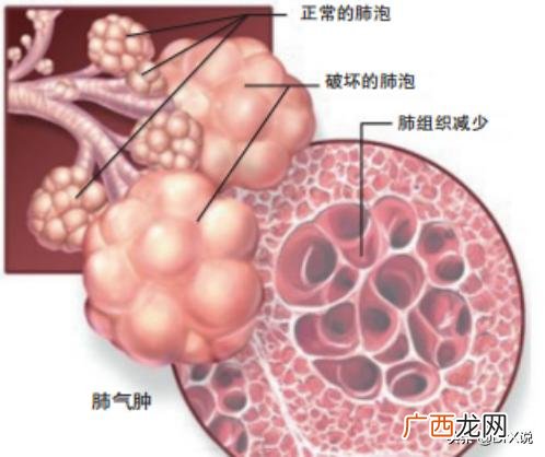 肺气肿是什么病,什么是肺气肿，肺气肿的症状有哪些？