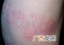 皮肤越抓越痒是什么原因,皮肤很痒一挠就脱白皮怎么回事?