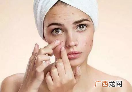 油痘肌怎么改善,一叶子油痘肌可以用吗？