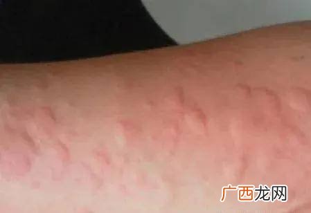 荨麻疹怎么样快速止痒,荨麻疹发作时怎样快速止痒?