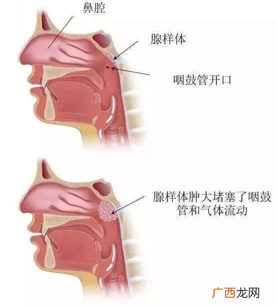 小孩清嗓子频繁怎么办,小孩老是清嗓子怎么办？