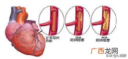 血脂高是什么原因,血脂高是什么原因引起的？