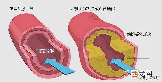 血脂高是什么原因,血脂高是什么原因引起的？