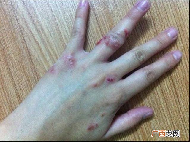 长湿疹是什么原因引起的,为什么人会得湿疹？