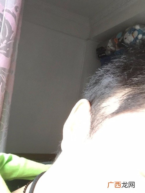 头发秃了怎么办,秃顶要怎么办？