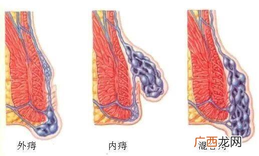 外痔长什么样,痔疮都是长在什么部位啊？