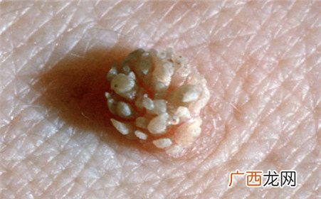 hpv感染有什么症状,hpv的症状是什么样的？