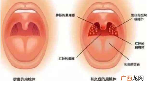 扁桃体的位置在消化道和呼吸道的交汇处 扁桃体在哪里