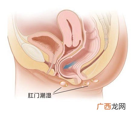 肛门潮湿什么原因,肛周潮湿是怎么回事引起的呢？