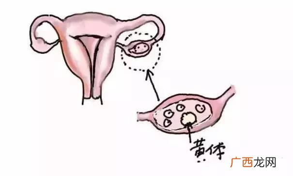 黄体酮破裂是怎么回事,黄体破裂是哪里痛？
