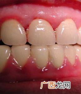 牙龈出血是什么病征兆,牙龈出血到底是怎么回事?