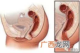 肛门上有个小肉球是怎么回事,肛门上有个小肉球怎么回事？