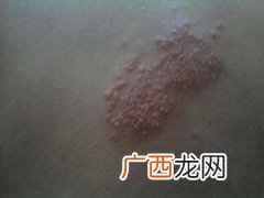 下面长水泡是什么病,鼻子上起水泡是什么原因？