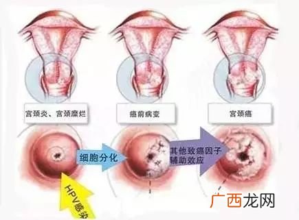 有hpv感染可以怀孕吗,HPV感染了还能怀孕吗？