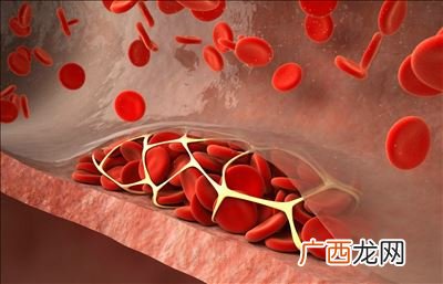血栓如何消除,腿血栓的最快消除方法?