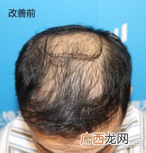 怎么确定是不是脂溢性脱发,女性脂溢性脱发有什么症状？