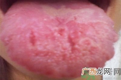 舌头有裂纹是什么原因,舌头上有裂痕是怎么回事？