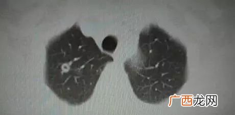 肺部小结节要紧吗,肺里有结节很严重吗？
