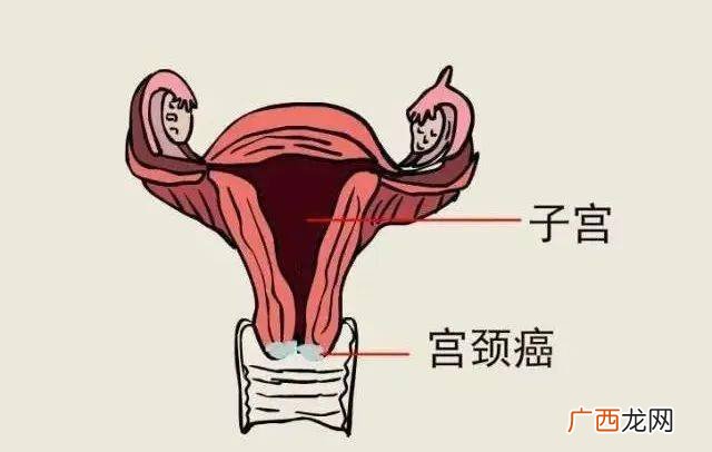 宫颈筛查是检查哪几项,女性该做宫颈癌筛查项目有哪些？