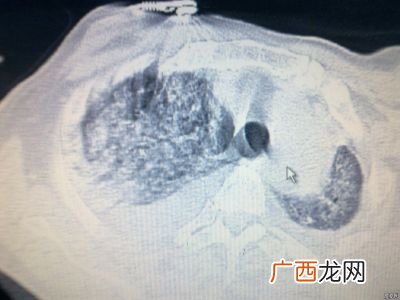 肺出血是什么原因引起,工地引起肺出血算不算工伤?