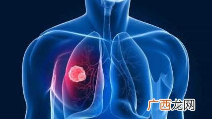 肺结节什么症状,肺结节的症状有哪些？