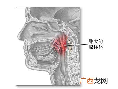 腺样体是哪个部位,腺样体结构图？