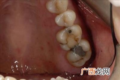 蛀牙是什么样子的,医生，请问：牙虫长什么样子？什么颜色？大？