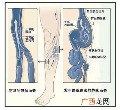 静脉曲张的危害有哪些,静脉曲张对人身体有哪些危害？