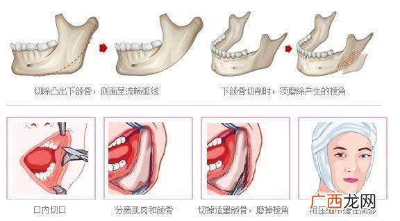 磨骨手术有什么风险和后遗症,磨骨有哪些后遗症？