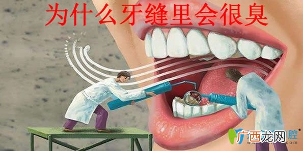 牙缝臭是什么原因,牙缝里塞东西很臭怎么回事？