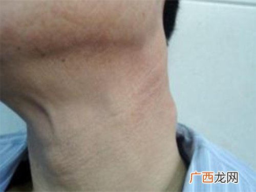 肿大淋巴结严重吗,淋巴结发炎肿大，严重吗？