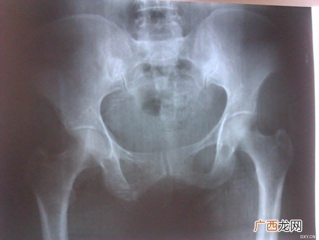 髋关节疼痛怎么治,髋关节疼痛吃什么药？