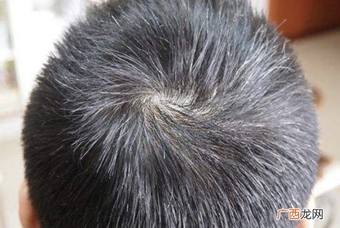 有白头发是什么原因引起的,三岁小孩头上有白头发是怎么一回事啊？
